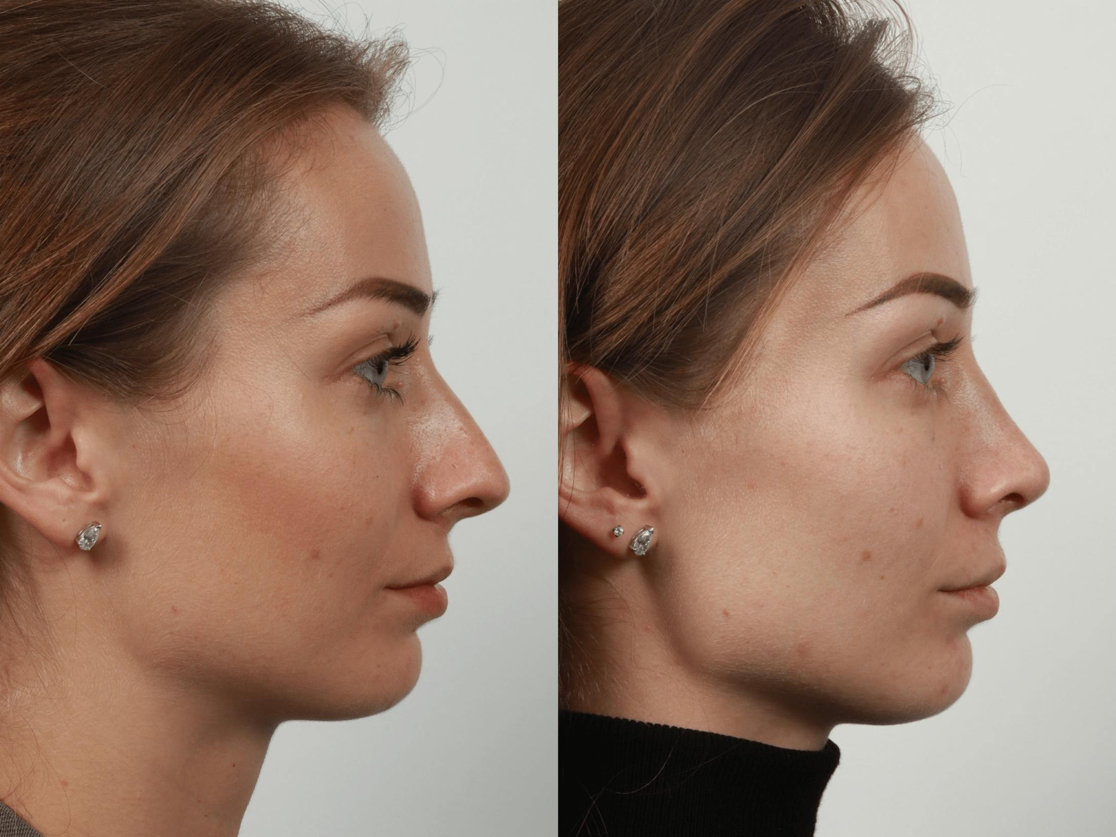 Rhinoplasty Before & After Gallery - Patient 55612936 - Image 2