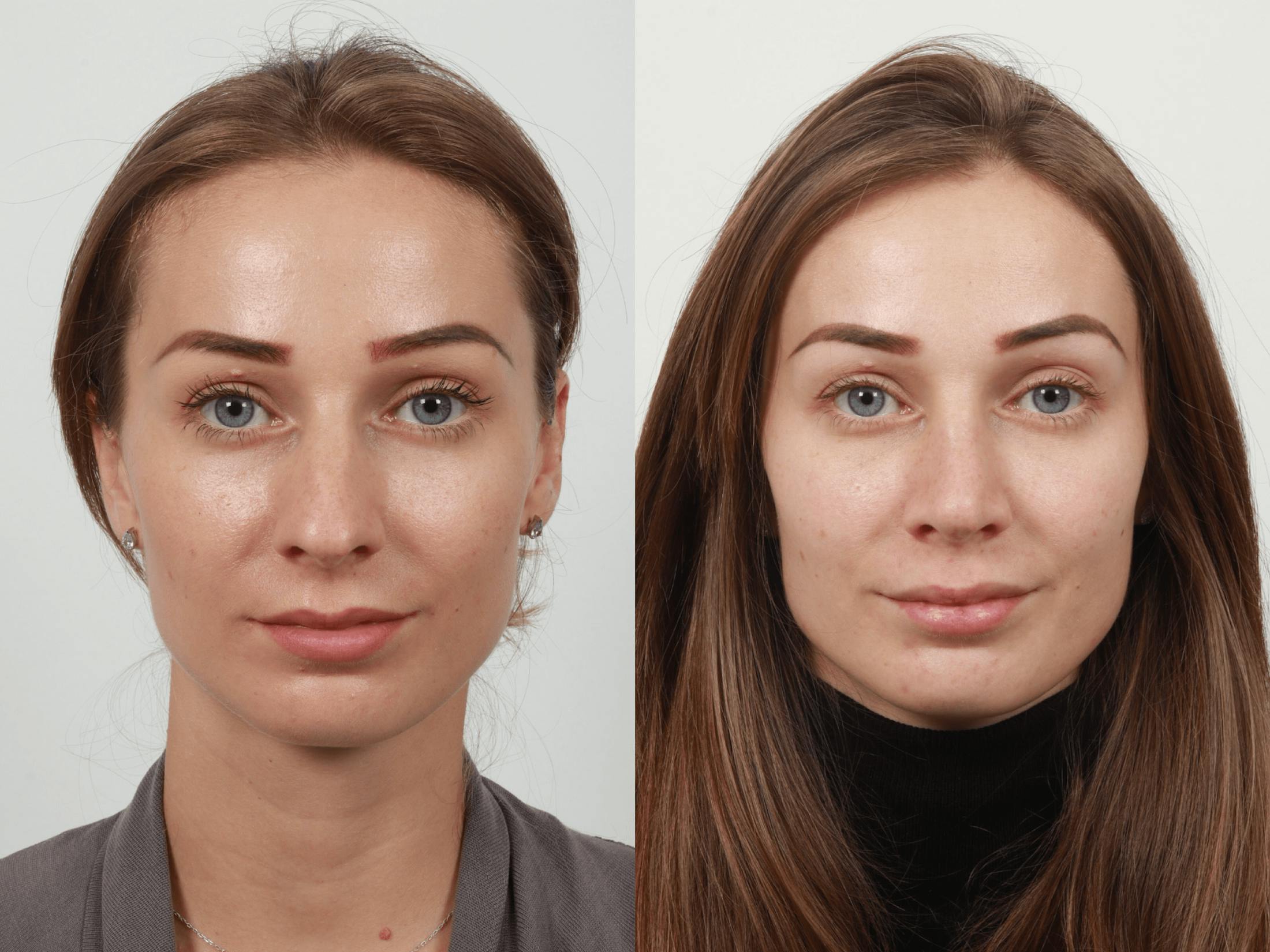 Rhinoplasty Before & After Gallery - Patient 55612936 - Image 3