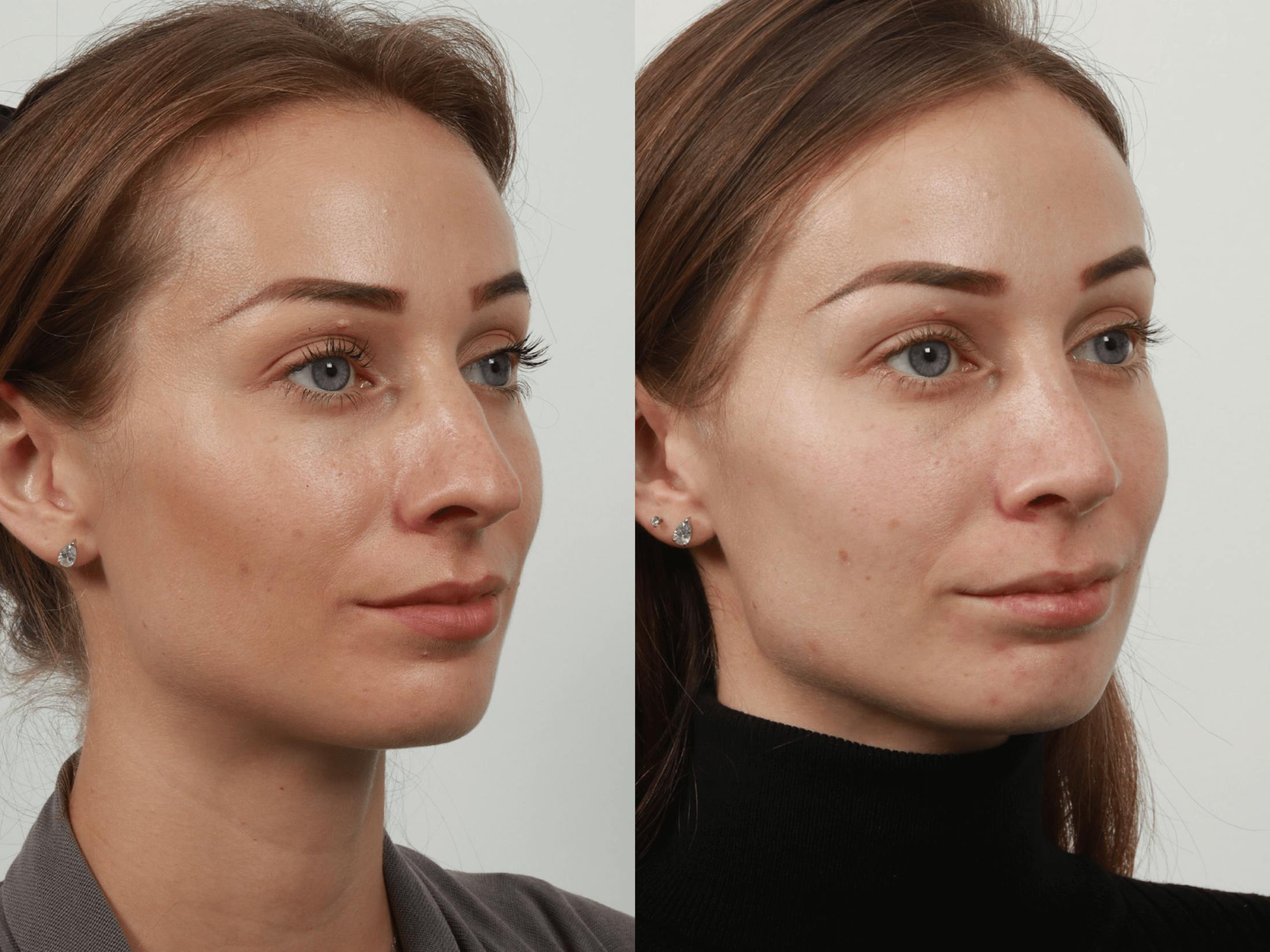 Rhinoplasty Before & After Gallery - Patient 55612936 - Image 4