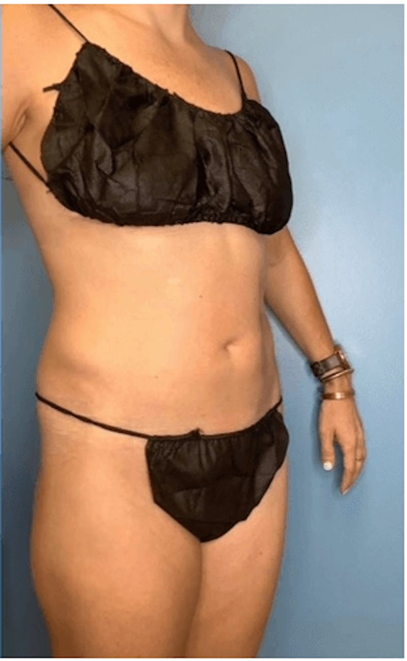 Emsculpt Neo® Before & After Gallery - Patient 55612935 - Image 2