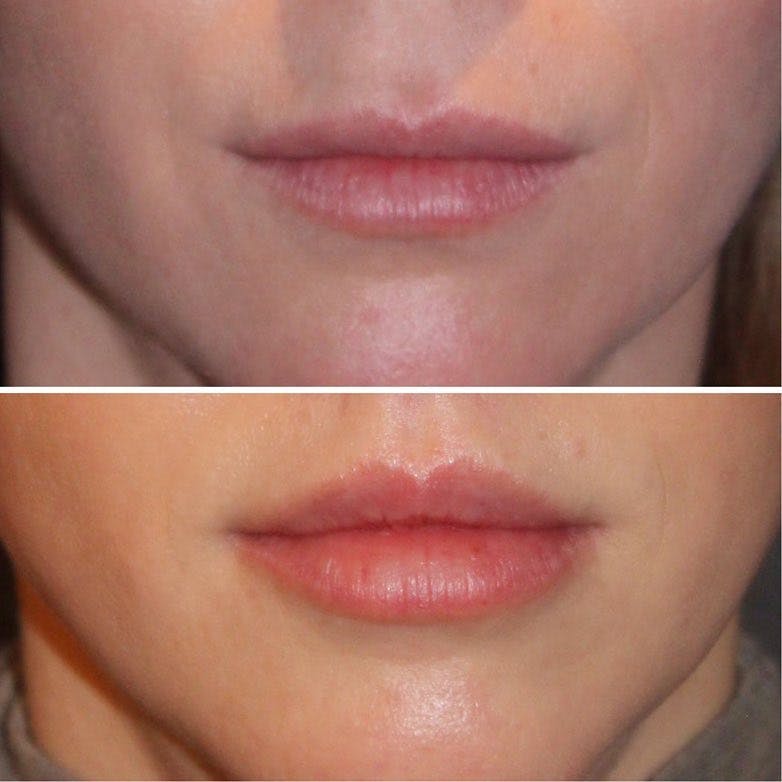 Lip Enhancement Before & After Gallery - Patient 60745113 - Image 1