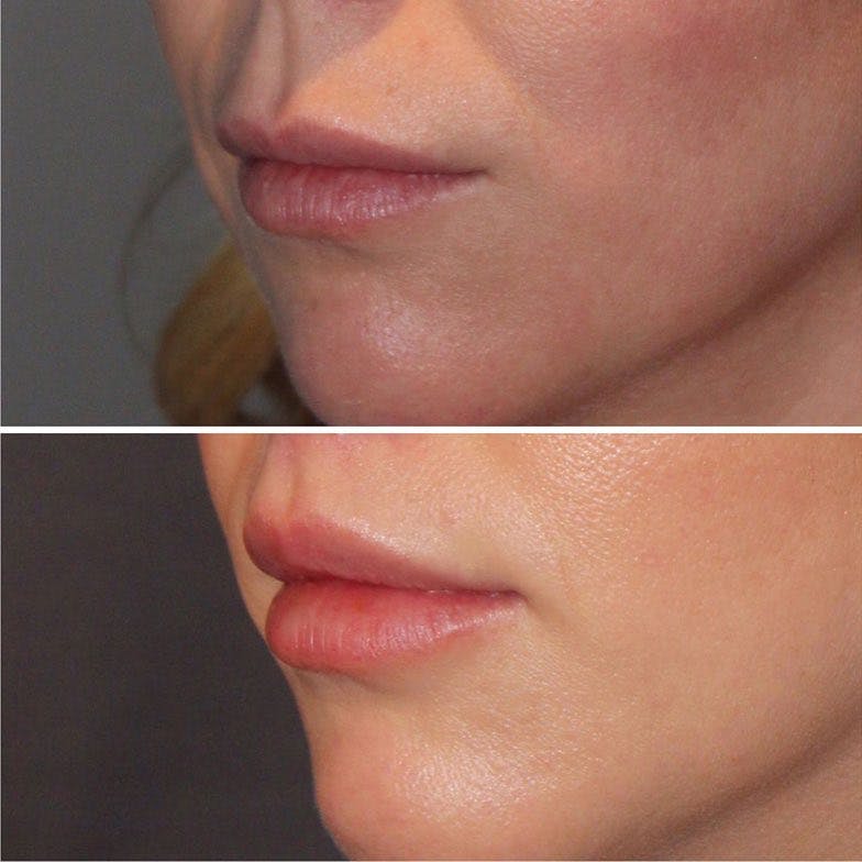 Lip Lift Before & After Gallery - Patient 60745113 - Image 2