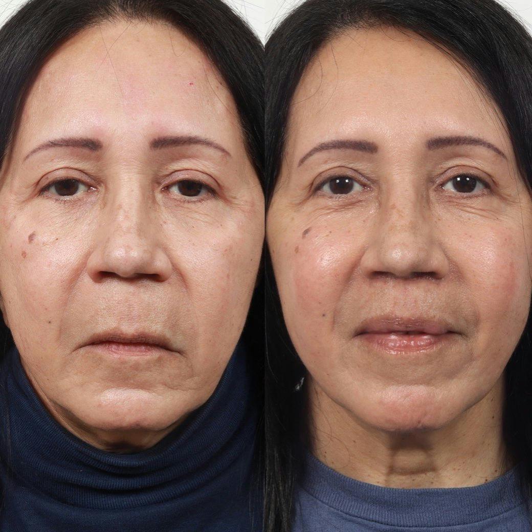 Lip Enhancement Before & After Gallery - Patient 60745240 - Image 1