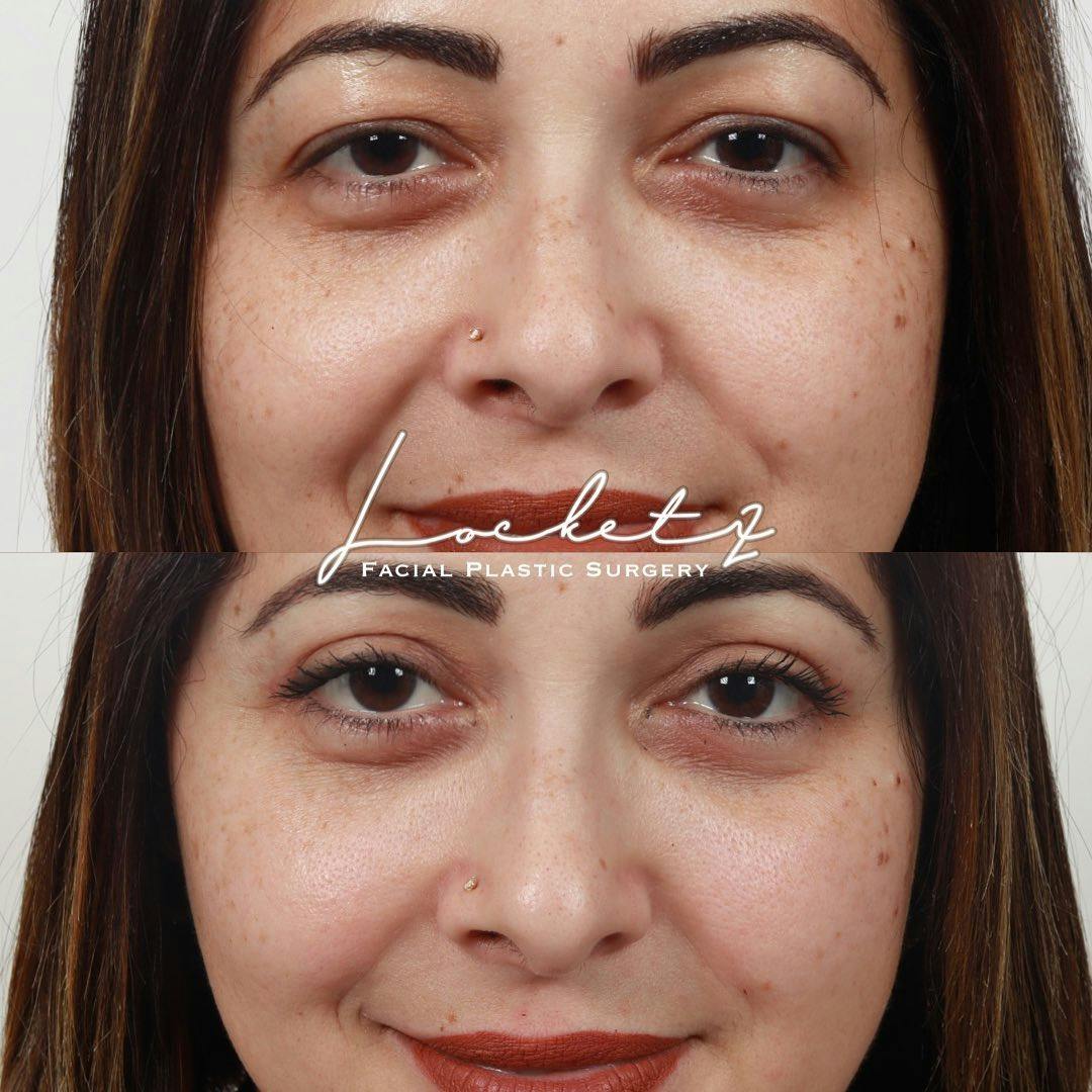 Eyelid Surgery Before & After Gallery - Patient 60745359 - Image 2