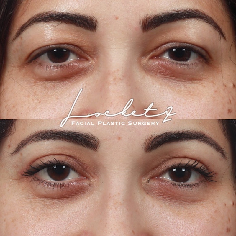 Eyelid Surgery Before & After Gallery - Patient 60745359 - Image 1