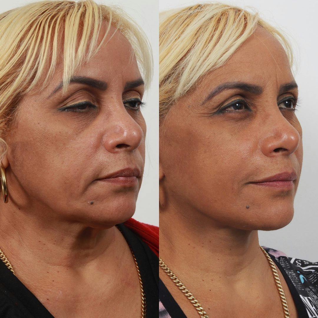 Deep Plane Facelift Before & After Gallery - Patient 60745403 - Image 1