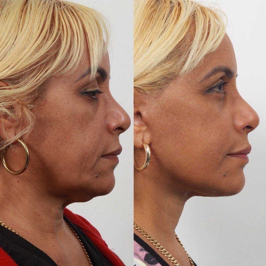 Deep Plane Facelift Before & After Gallery - Patient 60745403 - Image 2