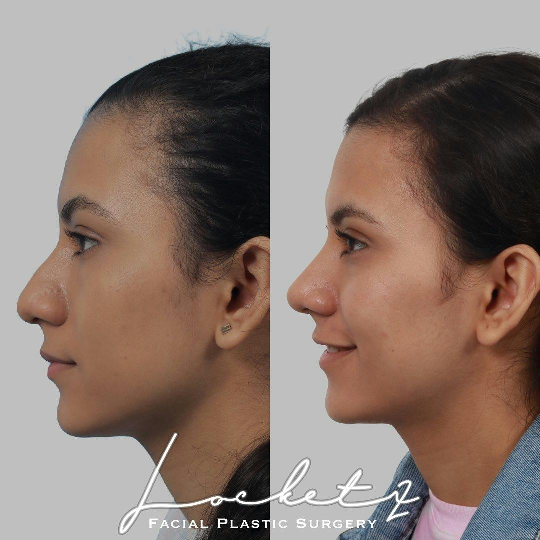Rhinoplasty Before & After Gallery - Patient 60745416 - Image 1