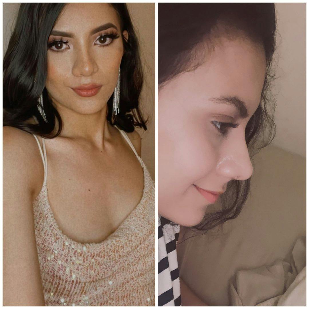 Rhinoplasty Before & After Gallery - Patient 60745416 - Image 2