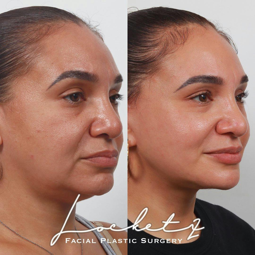Deep Plane Facelift Before & After Gallery - Patient 55610379 - Image 2