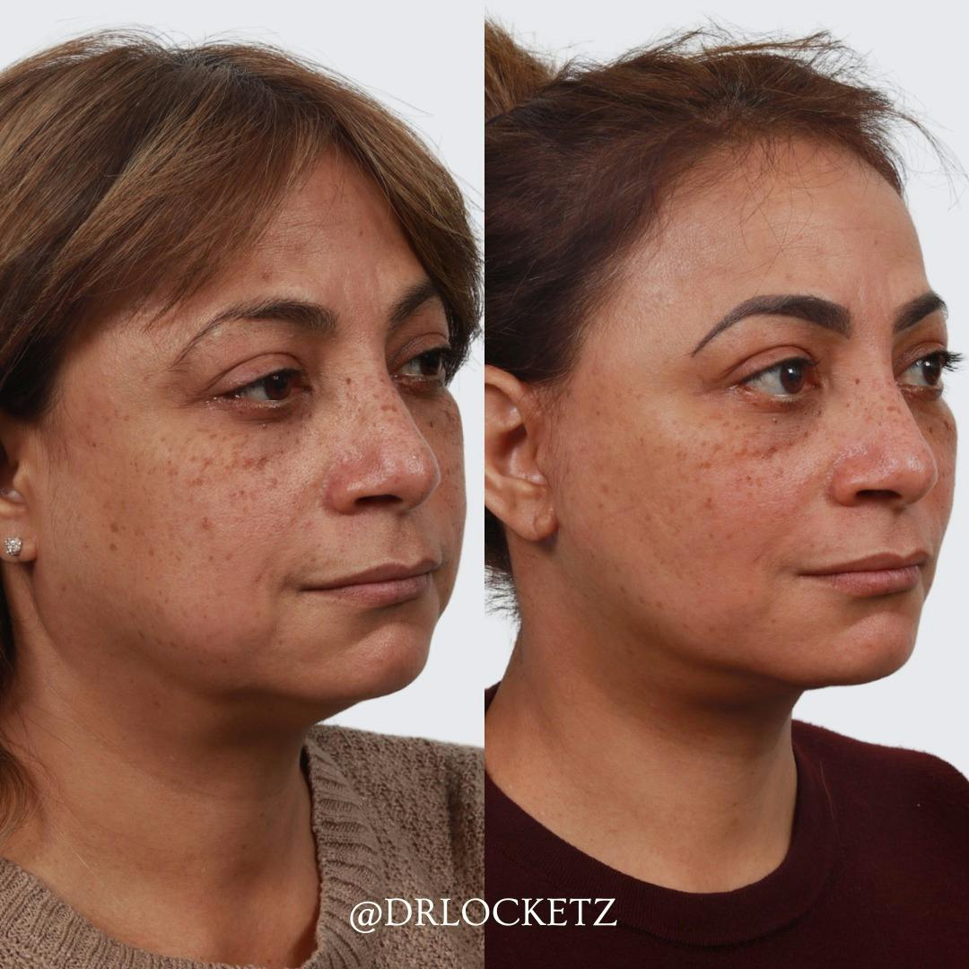 Deep Plane Facelift Before & After Gallery - Patient 60747124 - Image 2