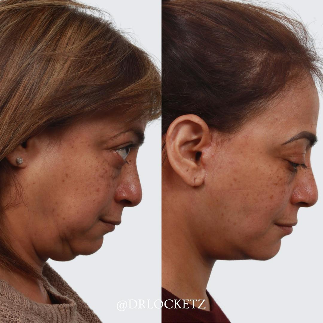 Buccal Fat Reduction Before & After Gallery - Patient 60747129 - Image 2