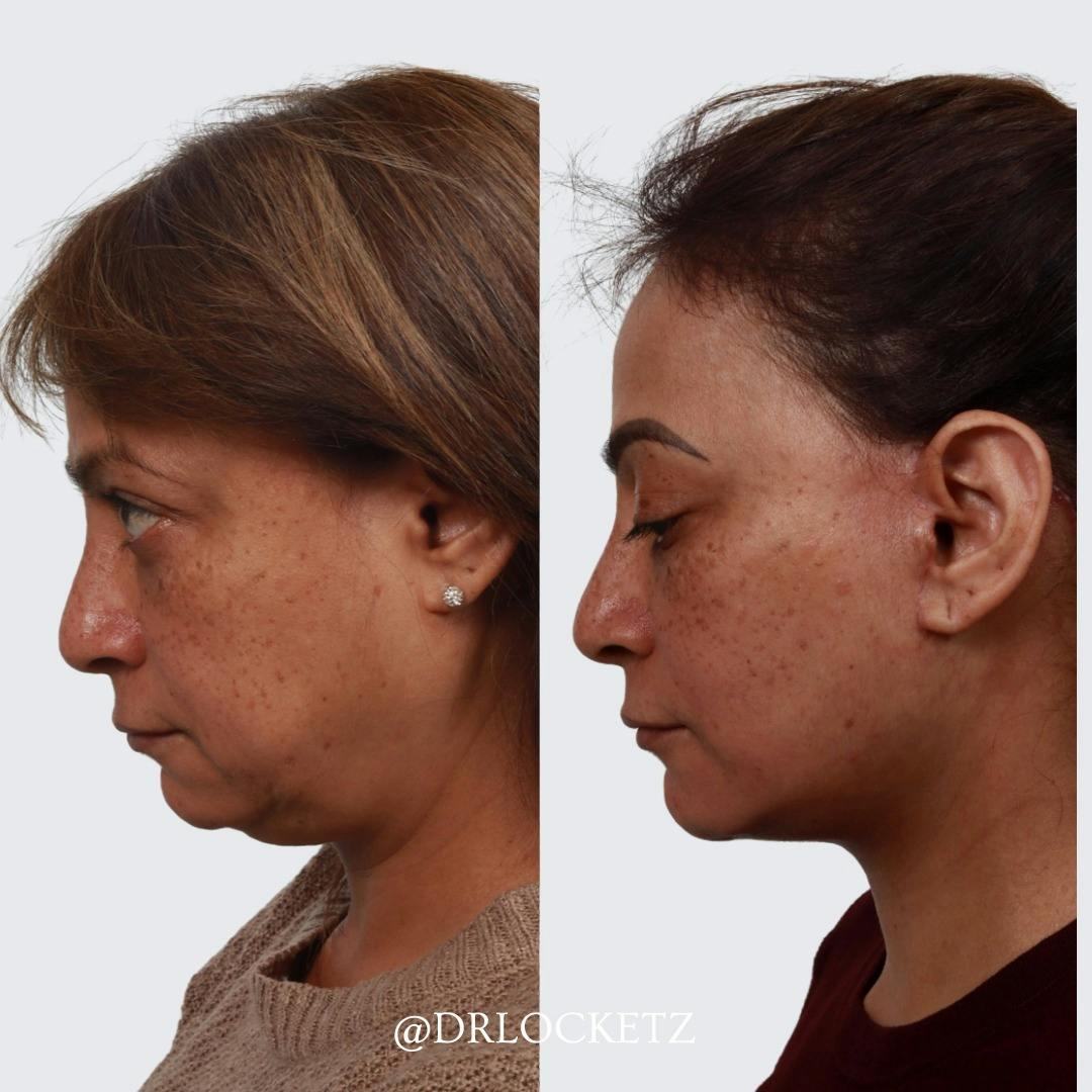 Buccal Fat Reduction Before & After Gallery - Patient 60747129 - Image 3