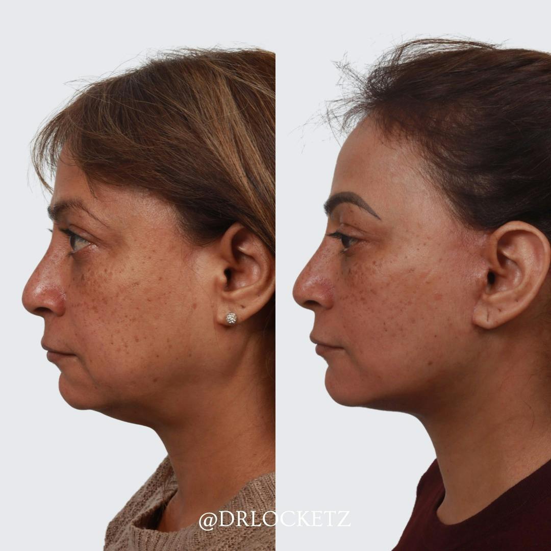 Buccal Fat Reduction Before & After Gallery - Patient 60747129 - Image 4