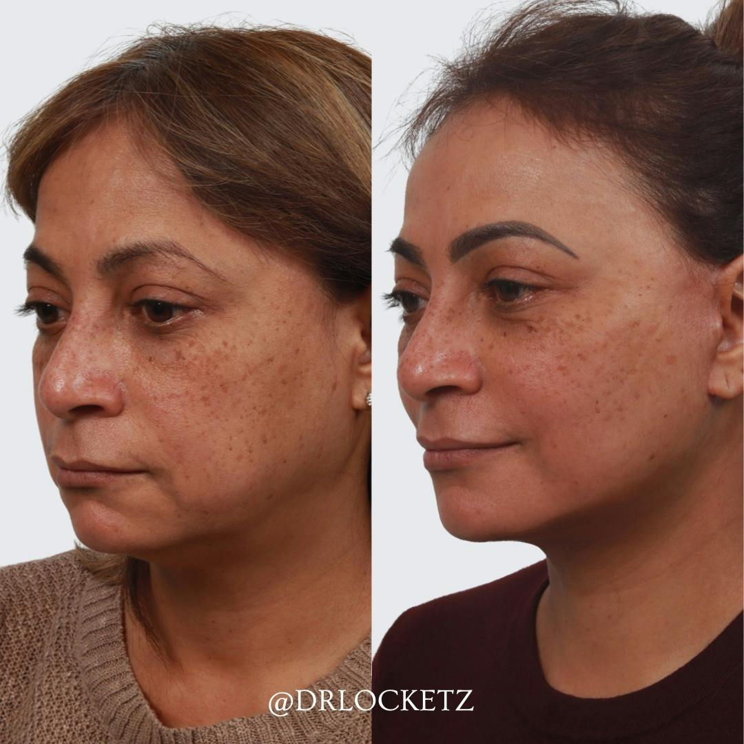 Buccal Fat Reduction Before & After Gallery - Patient 60747129 - Image 5