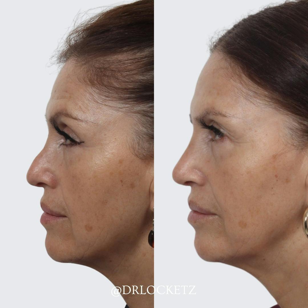 Rhinoplasty Before & After Gallery - Patient 55611654 - Image 1