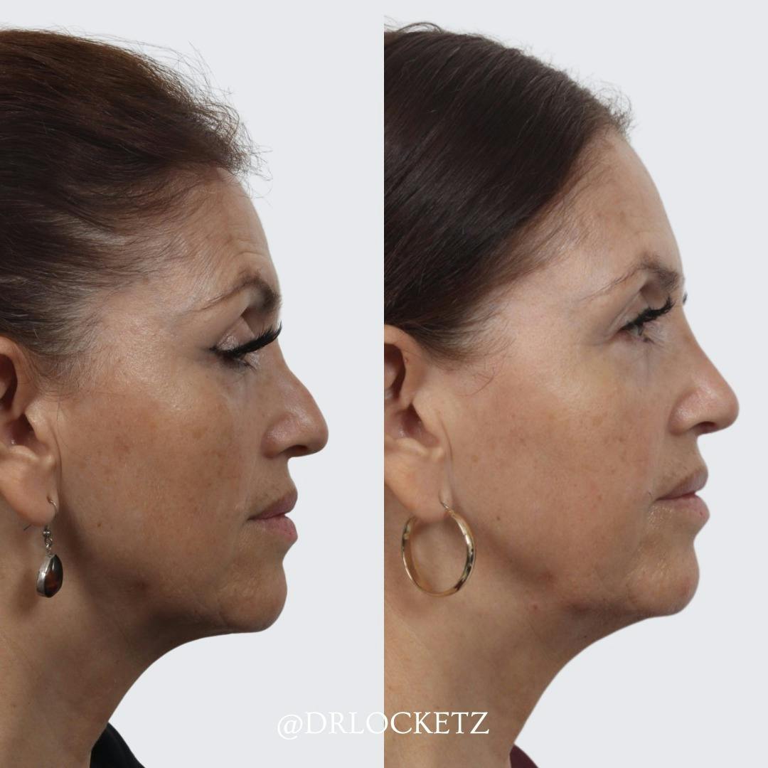 Rhinoplasty Before & After Gallery - Patient 55611654 - Image 2