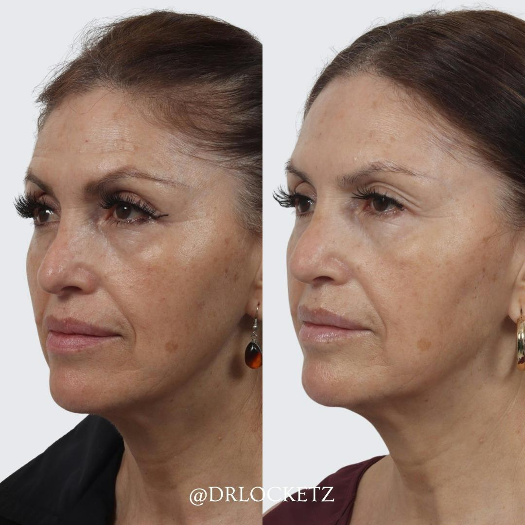 Rhinoplasty Before & After Gallery - Patient 55611654 - Image 3