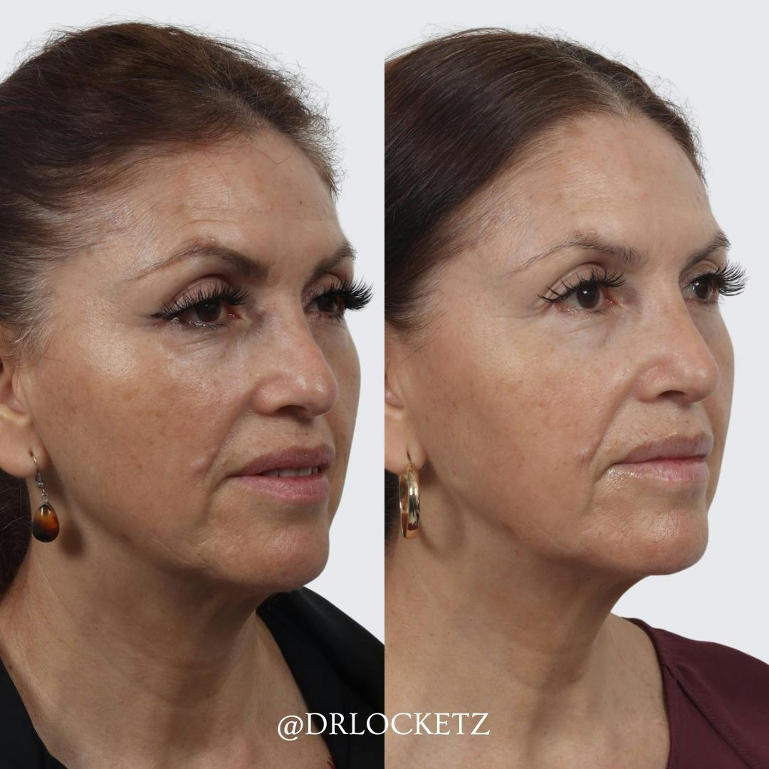 Rhinoplasty Before & After Gallery - Patient 55611654 - Image 4