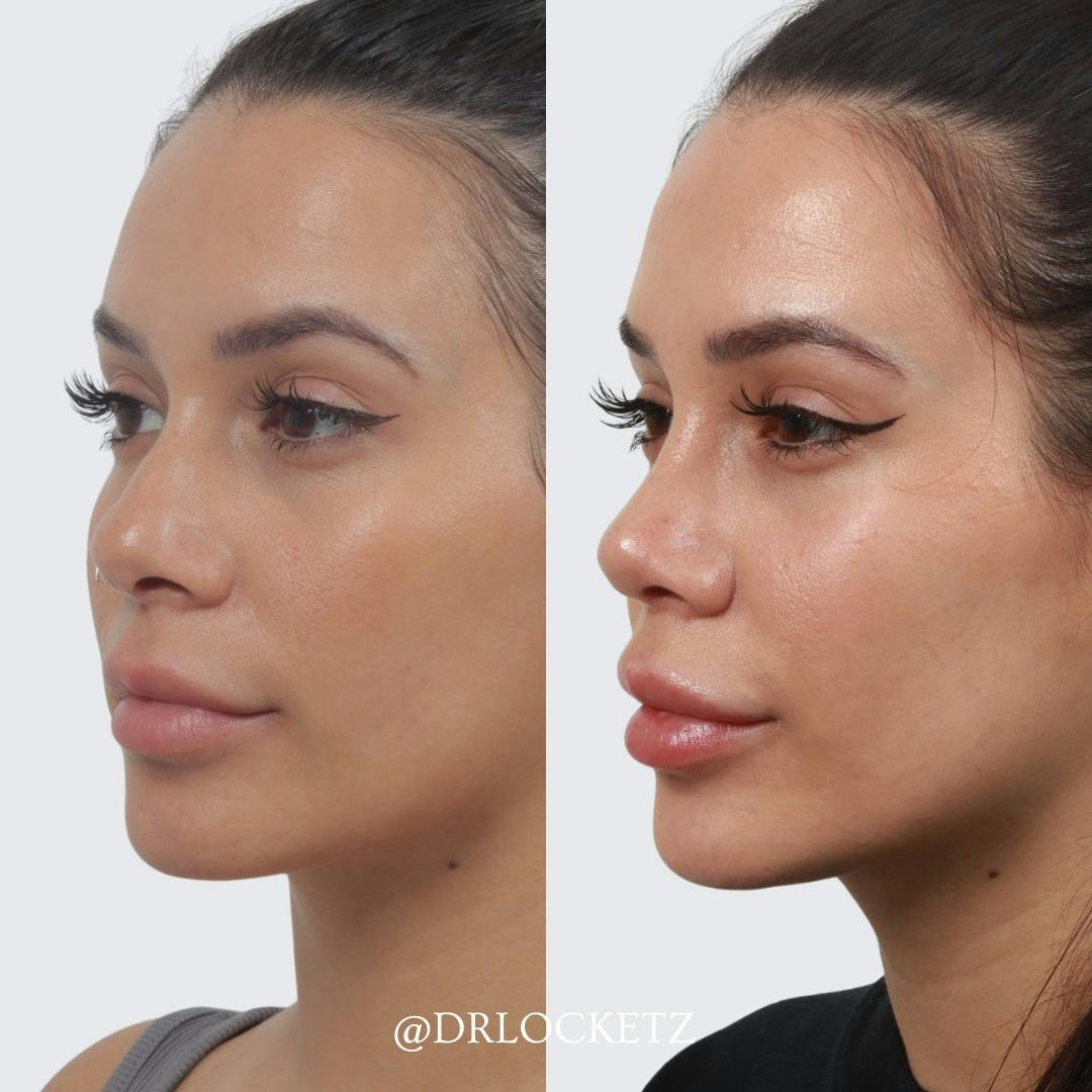 Rhinoplasty Before & After Gallery - Patient 60747312 - Image 3