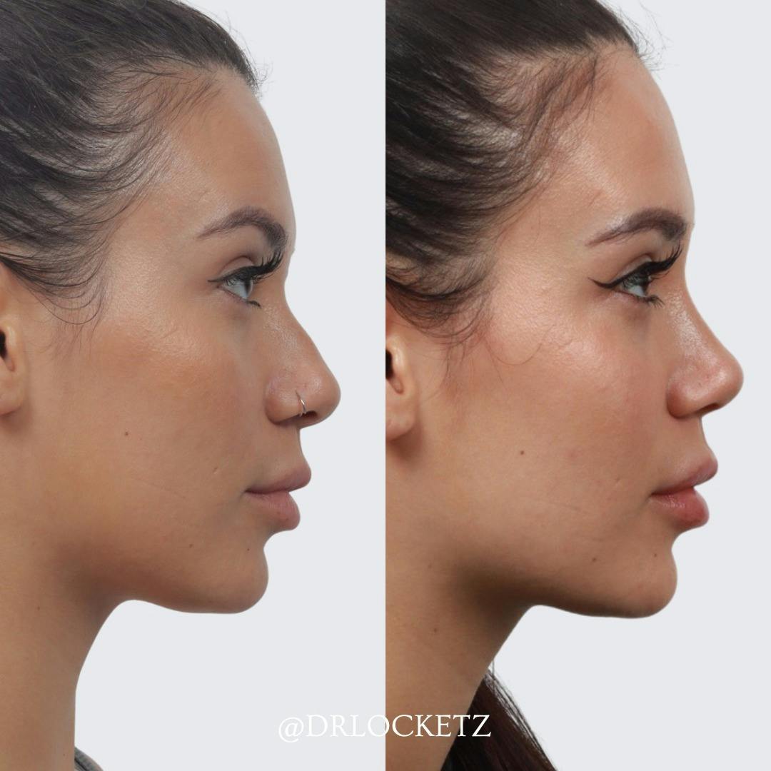 Rhinoplasty Before & After Gallery - Patient 60747312 - Image 2