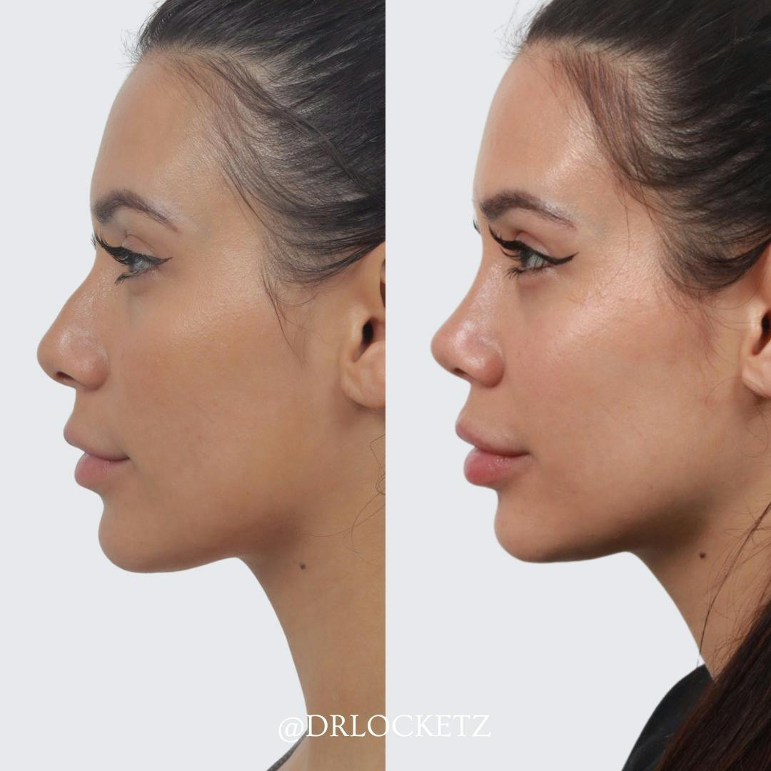 Rhinoplasty Before & After Gallery - Patient 60747312 - Image 1