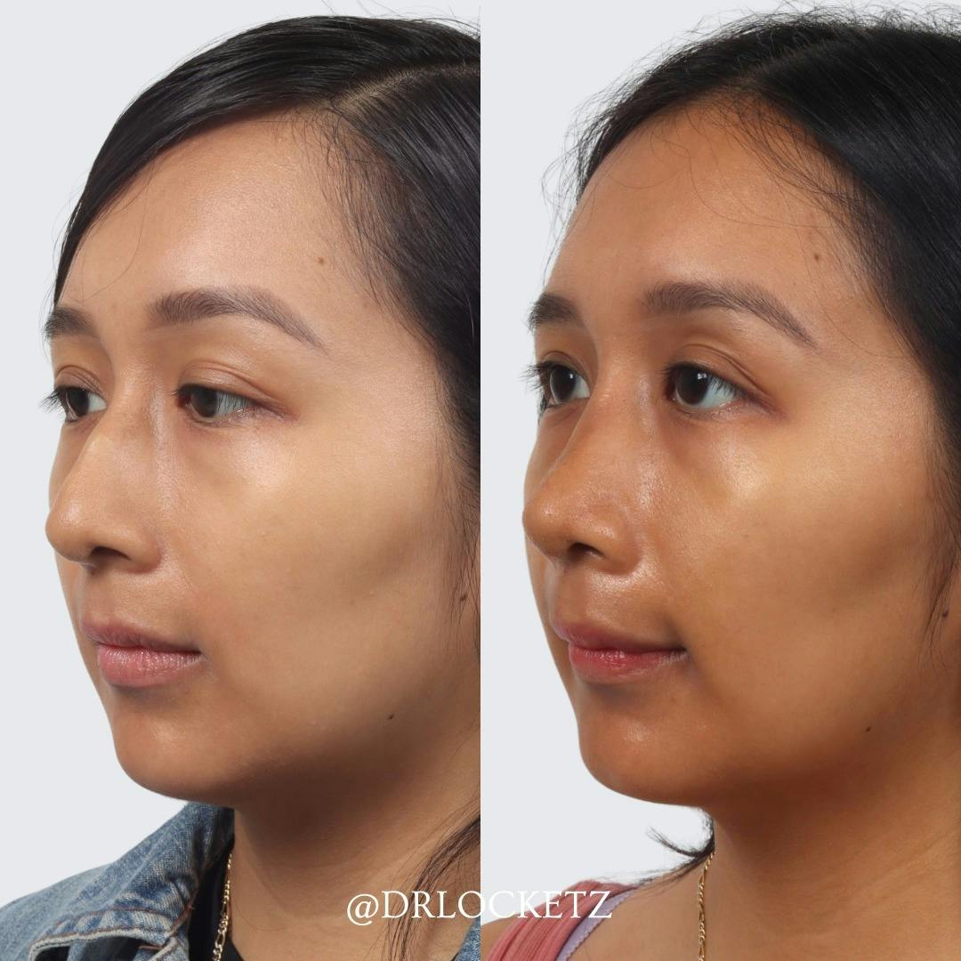 Rhinoplasty Before & After Gallery - Patient 55612923 - Image 3