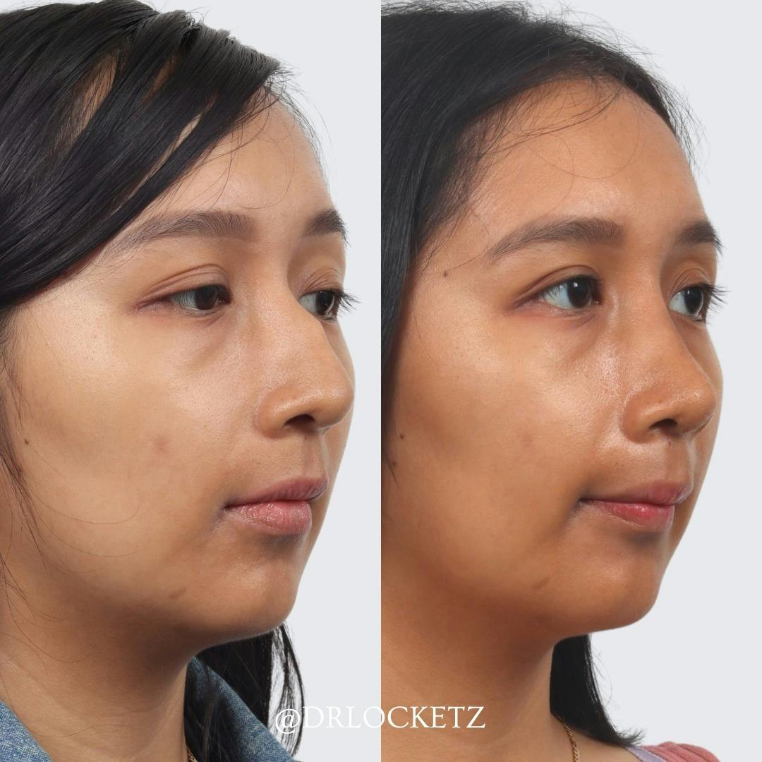 Rhinoplasty Before & After Gallery - Patient 55612923 - Image 2