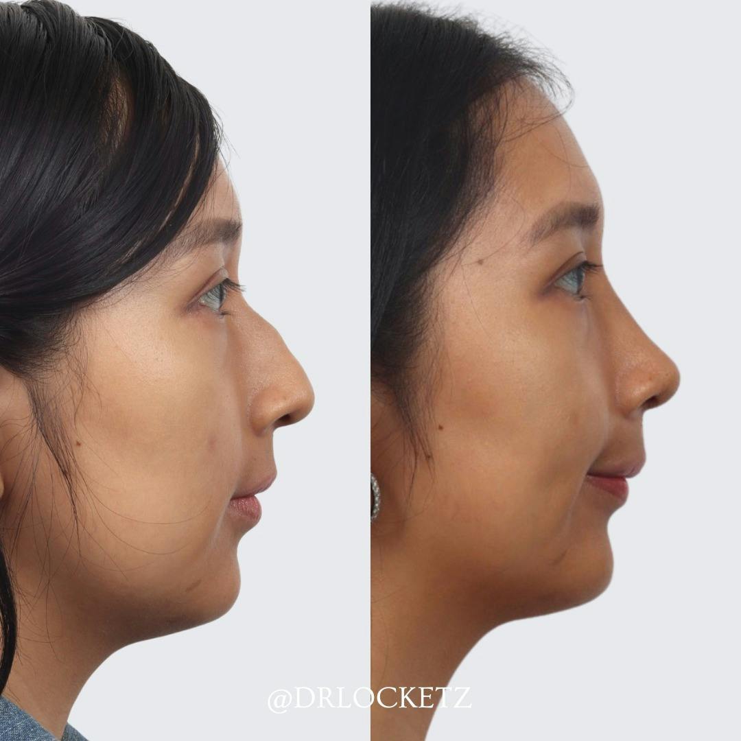 Rhinoplasty Before & After Gallery - Patient 55612923 - Image 4