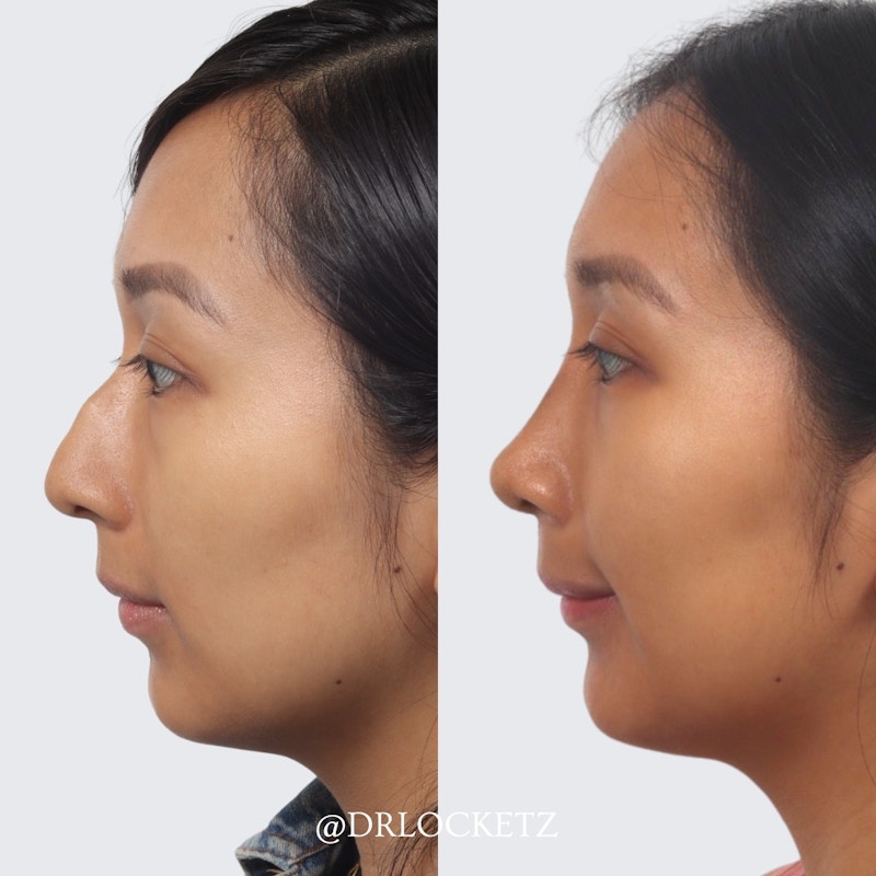 Rhinoplasty Before & After Gallery - Patient 55612923 - Image 1