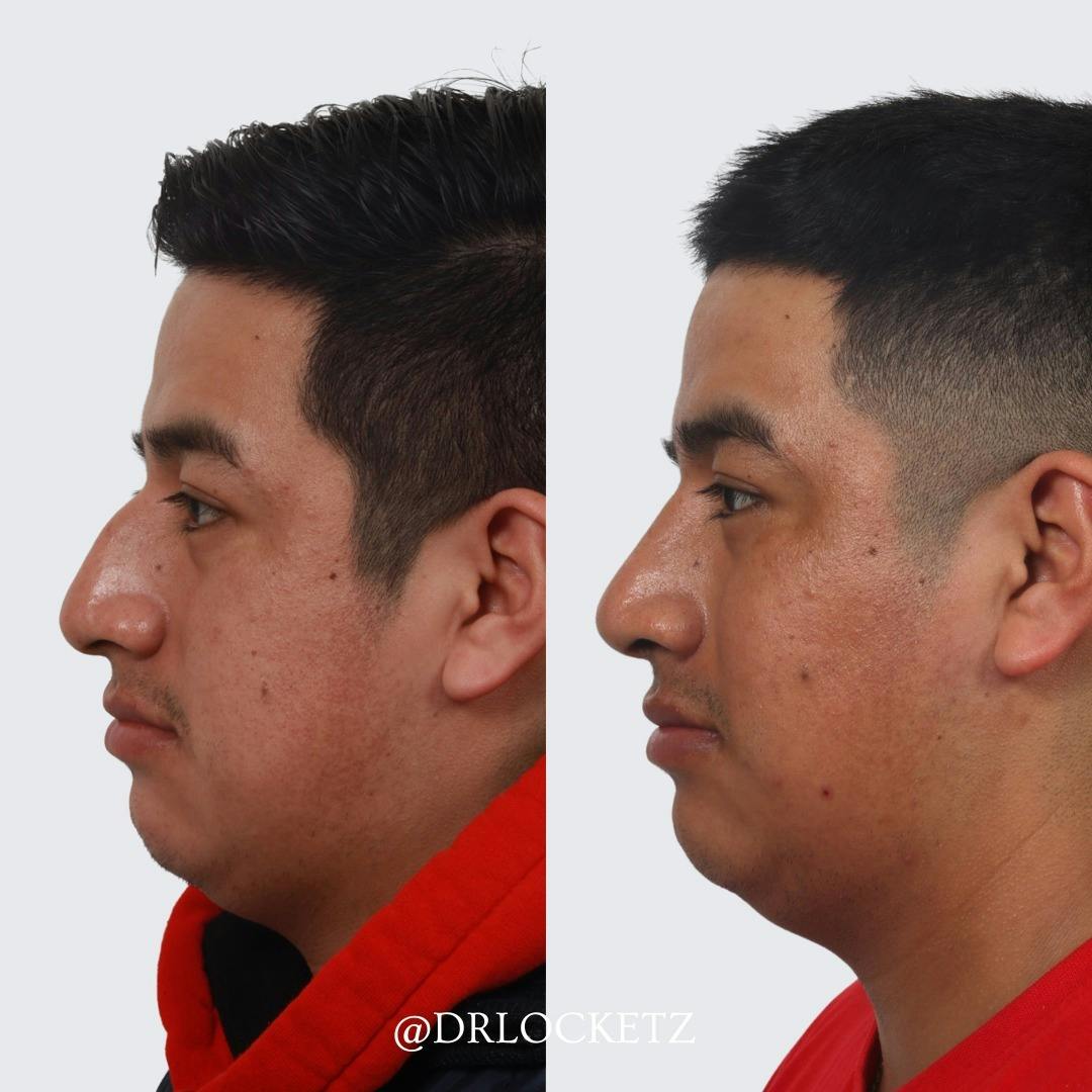 Rhinoplasty Before & After Gallery - Patient 60747320 - Image 1