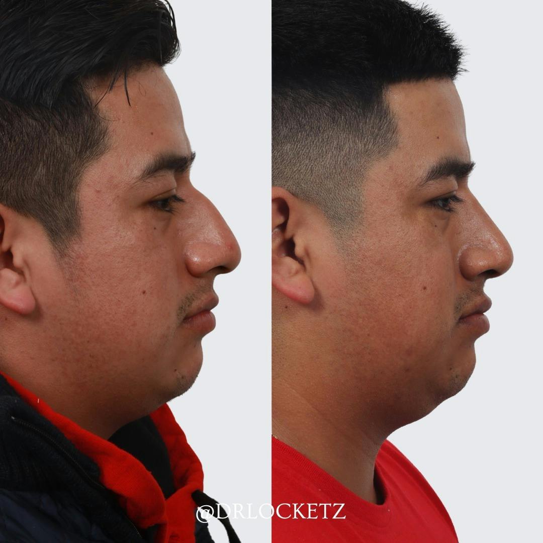 Rhinoplasty Before & After Gallery - Patient 60747320 - Image 2