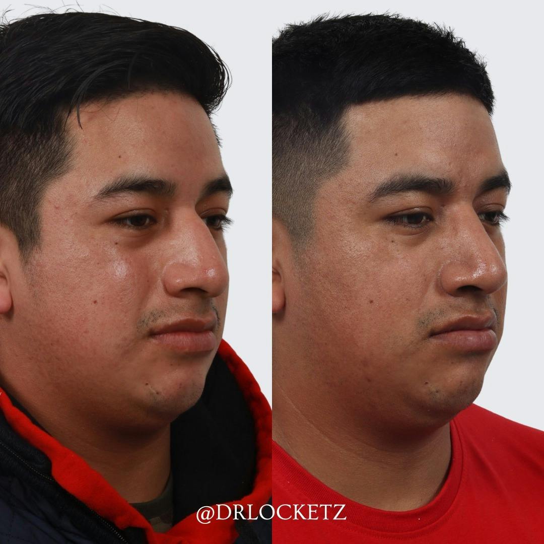 Rhinoplasty Before & After Gallery - Patient 60747320 - Image 3