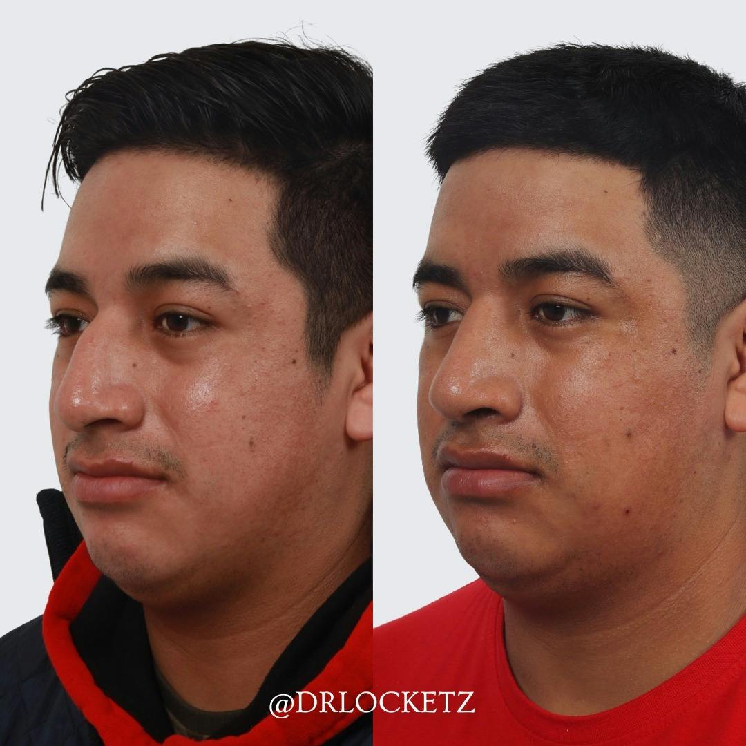 Rhinoplasty Before & After Gallery - Patient 60747320 - Image 4