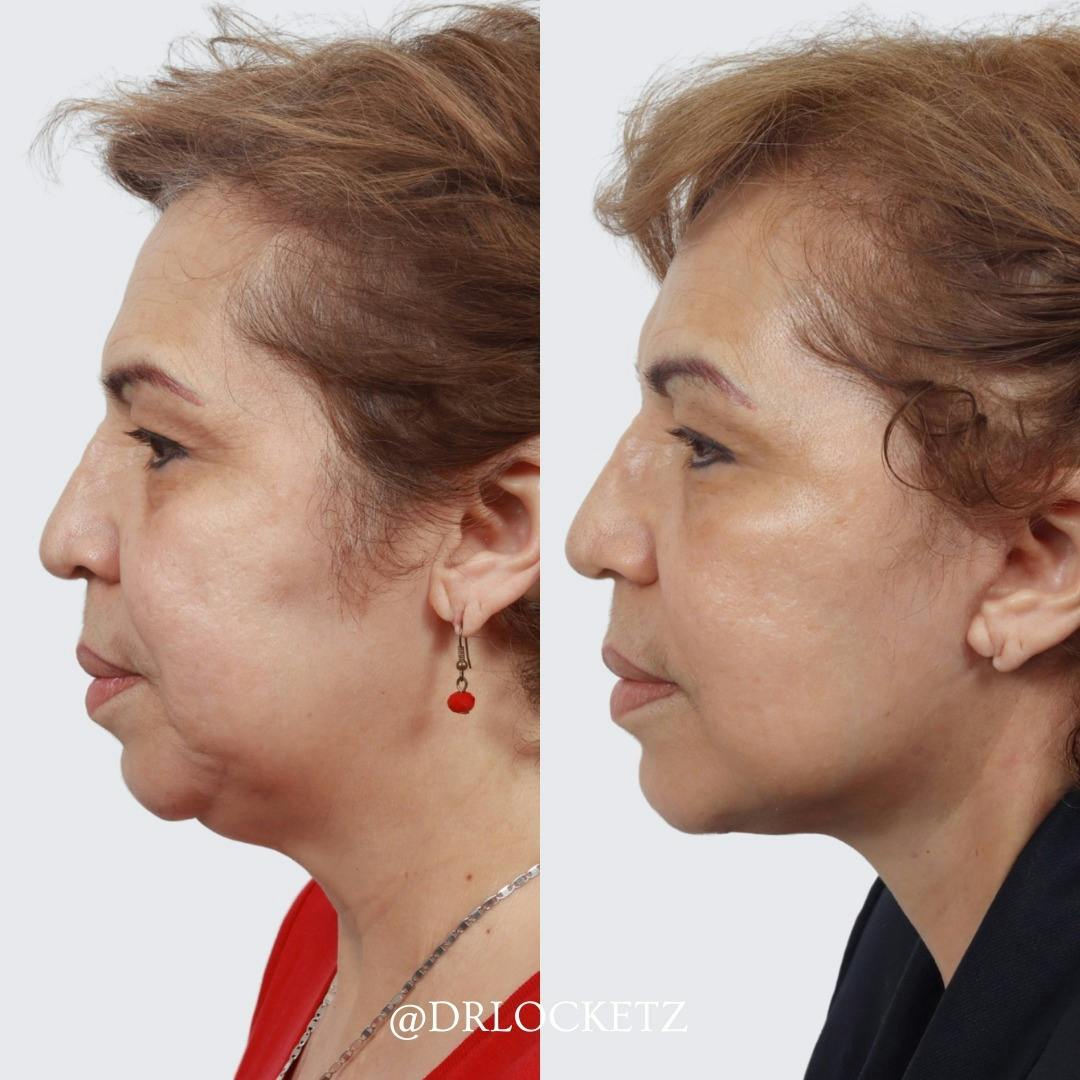 Deep Plane Facelift Before & After Gallery - Patient 60747326 - Image 2