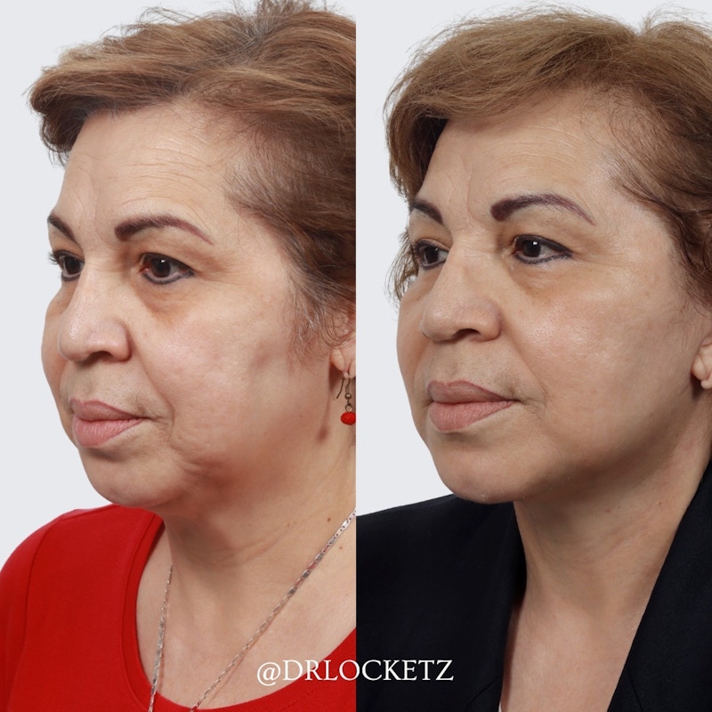 Deep Plane Facelift Before & After Gallery - Patient 60747326 - Image 1