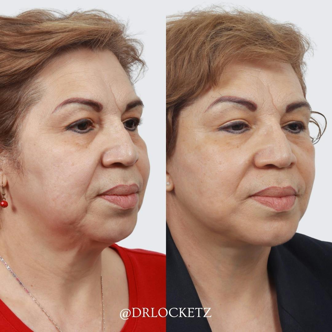Deep Plane Facelift Before & After Gallery - Patient 60747326 - Image 3