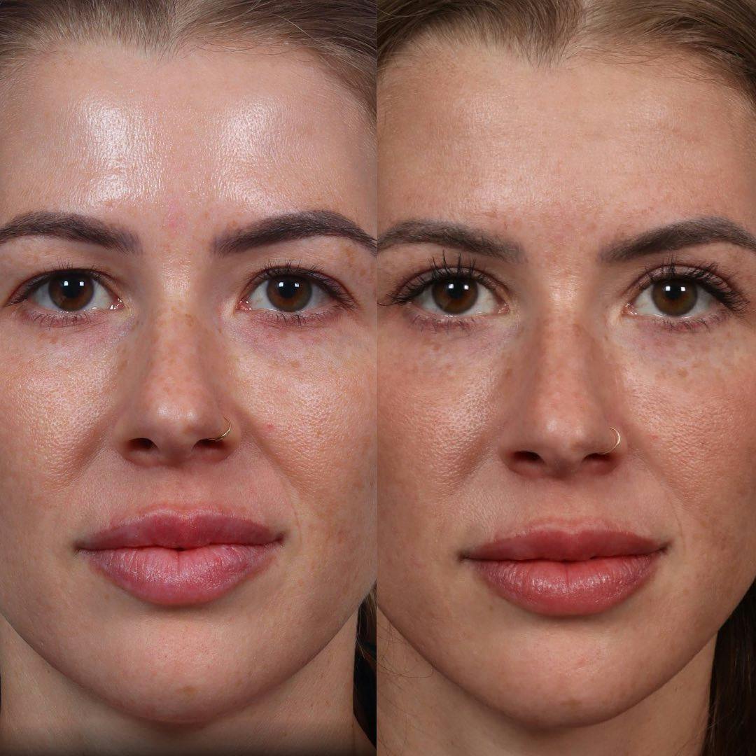 Eyelid Surgery Before & After Gallery - Patient 60747907 - Image 2