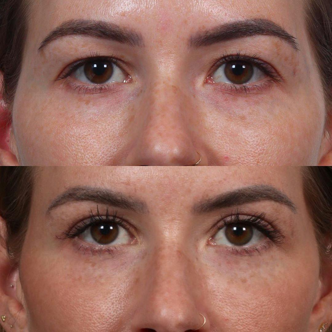 Eyelid Surgery Before & After Gallery - Patient 60747907 - Image 1