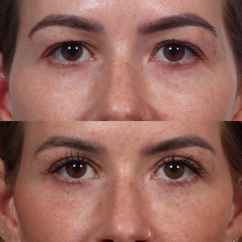 Eyelid Surgery (Blepharoplasty) Before & After Gallery - Patient 60747907 - Image 1