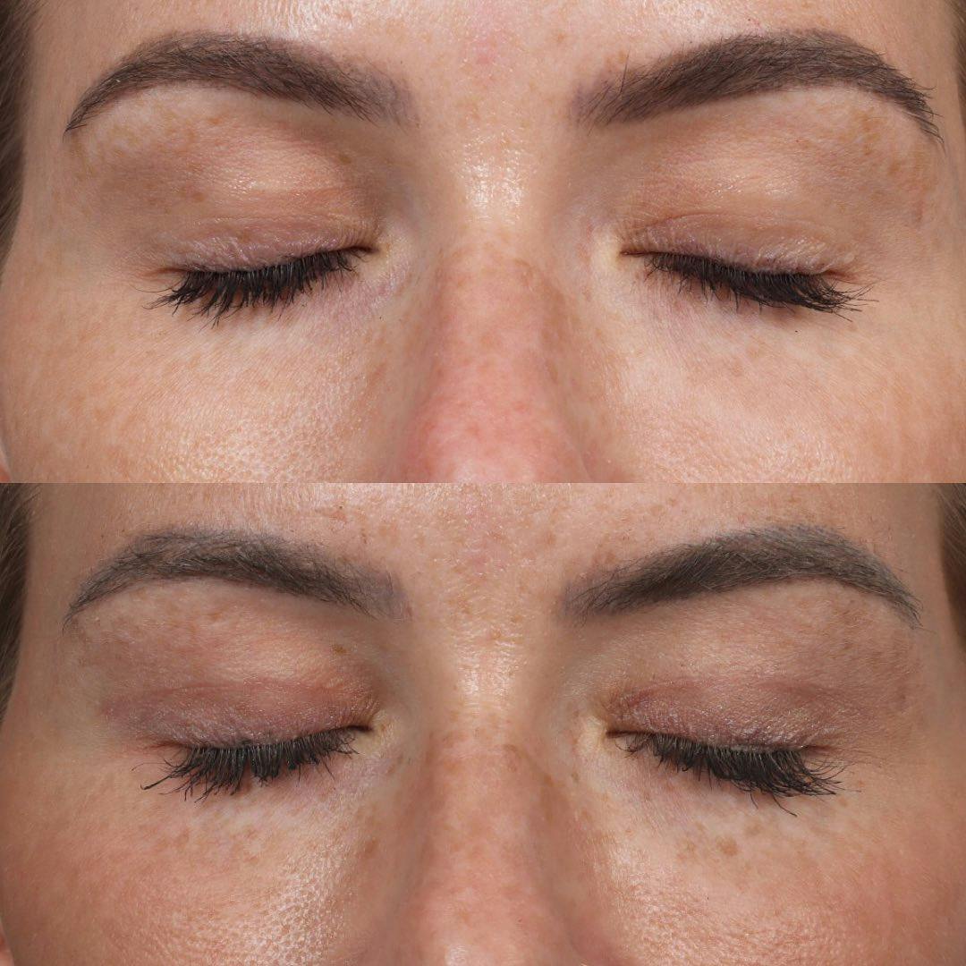 Eyelid Surgery Before & After Gallery - Patient 60747907 - Image 4