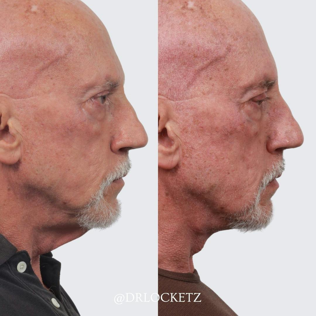 Deep Neck Lift Before & After Gallery - Patient 60747931 - Image 3