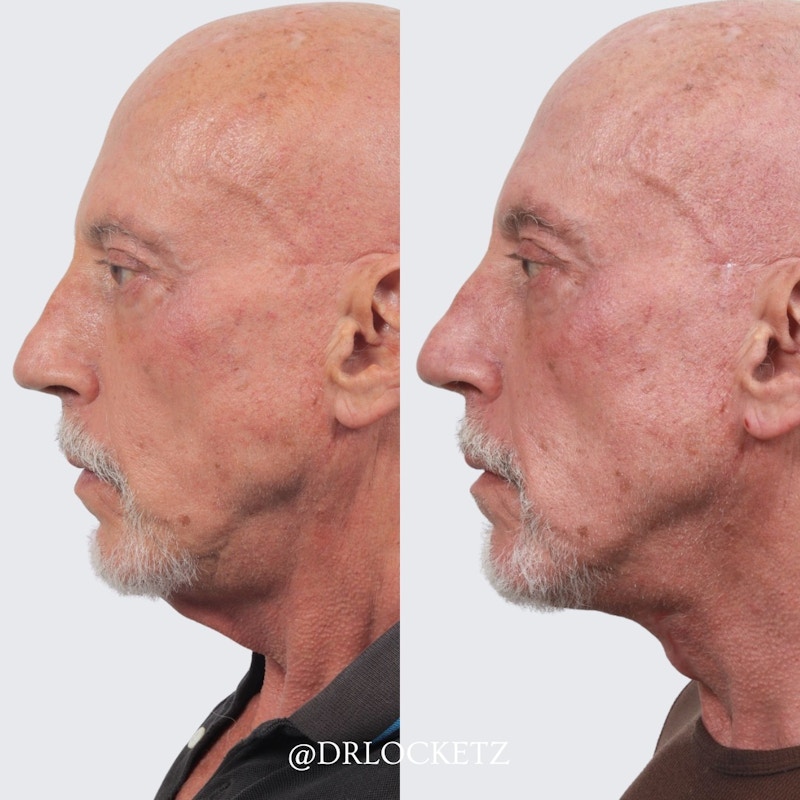 Deep Neck Lift Before & After Gallery - Patient 60747931 - Image 1
