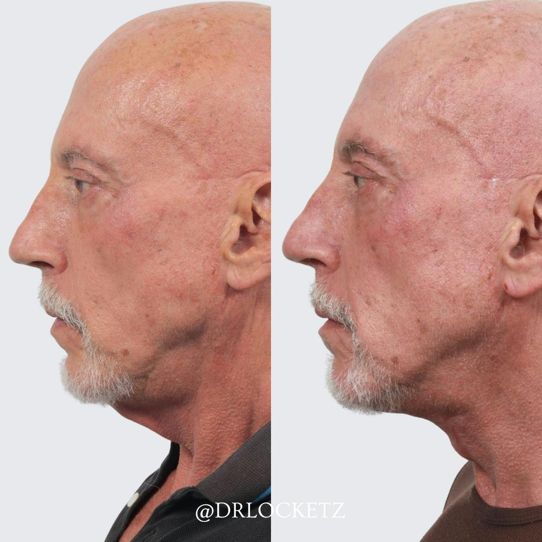 Deep Neck Lift Before & After Gallery - Patient 60747931 - Image 3