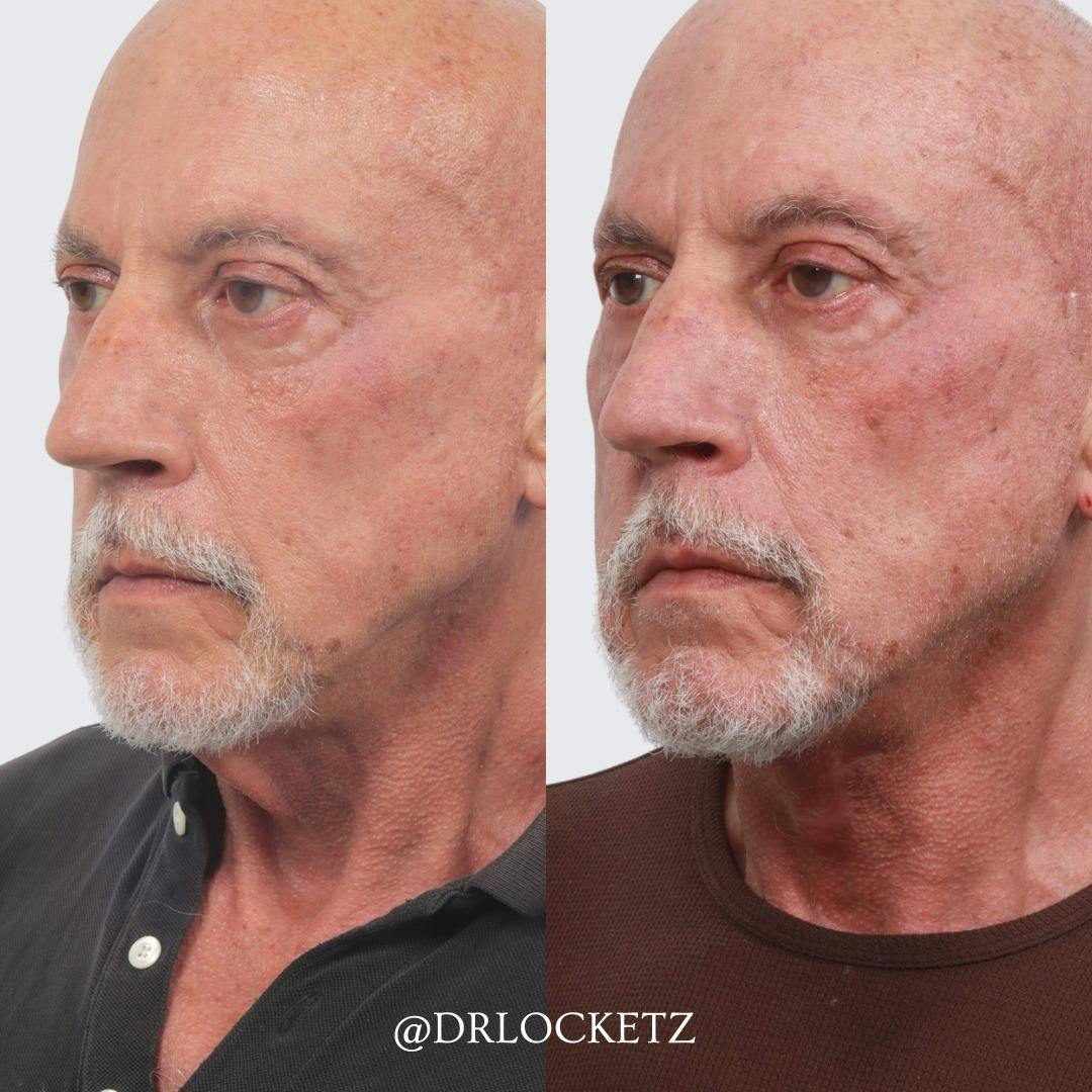 Deep Neck Lift Before & After Gallery - Patient 60747931 - Image 4