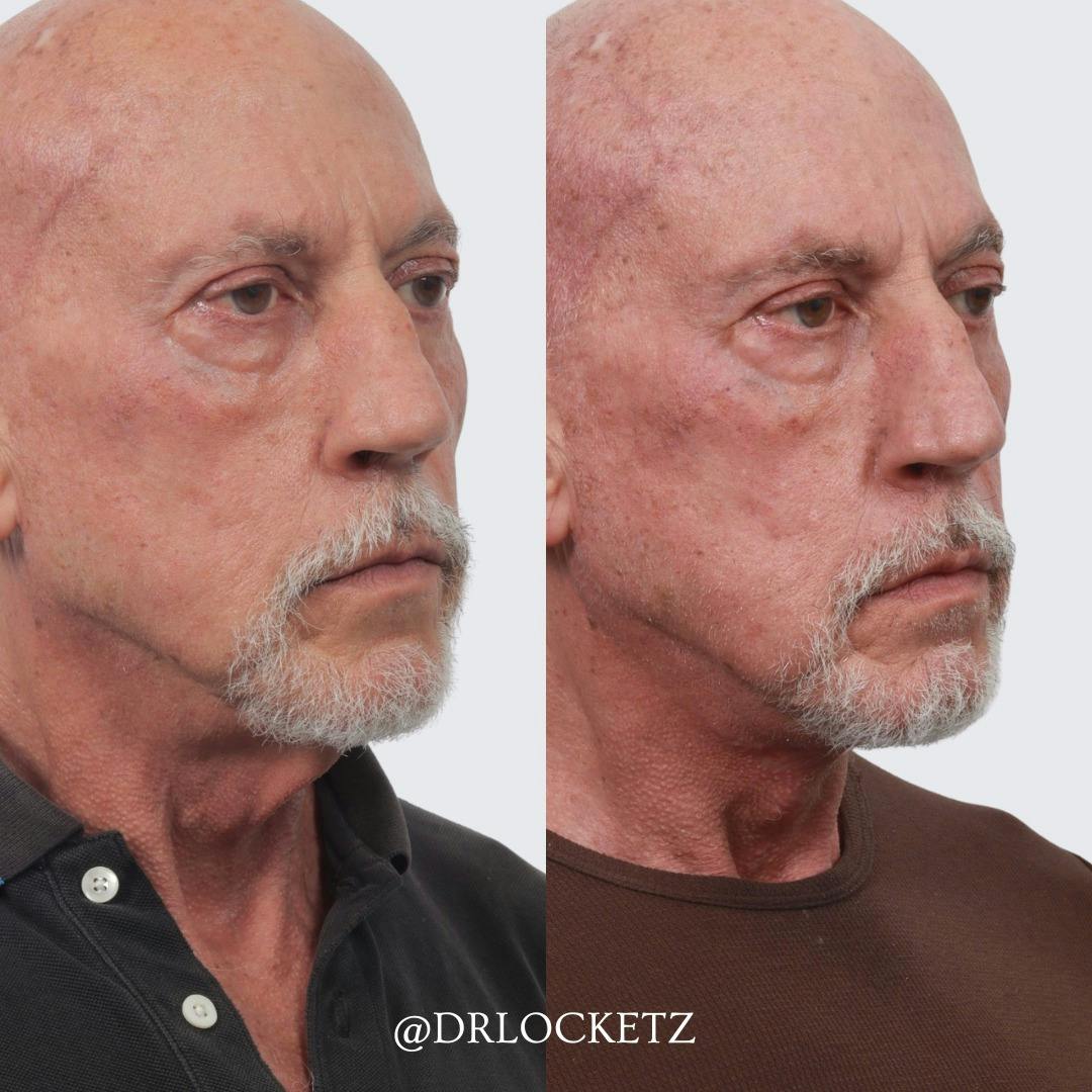 Deep Neck Lift Before & After Gallery - Patient 60747931 - Image 2