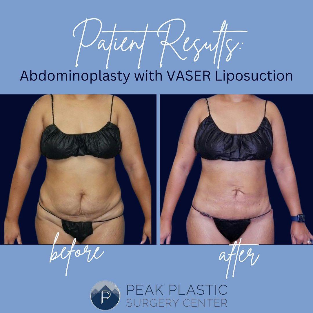 Vaser Liposuction Before & After Gallery - Patient 60747986 - Image 1