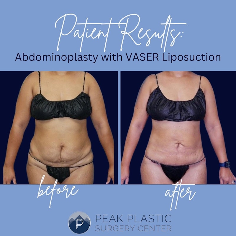 Tummy Tuck (Abdominoplasty)  Before & After Gallery - Patient 60747938 - Image 1