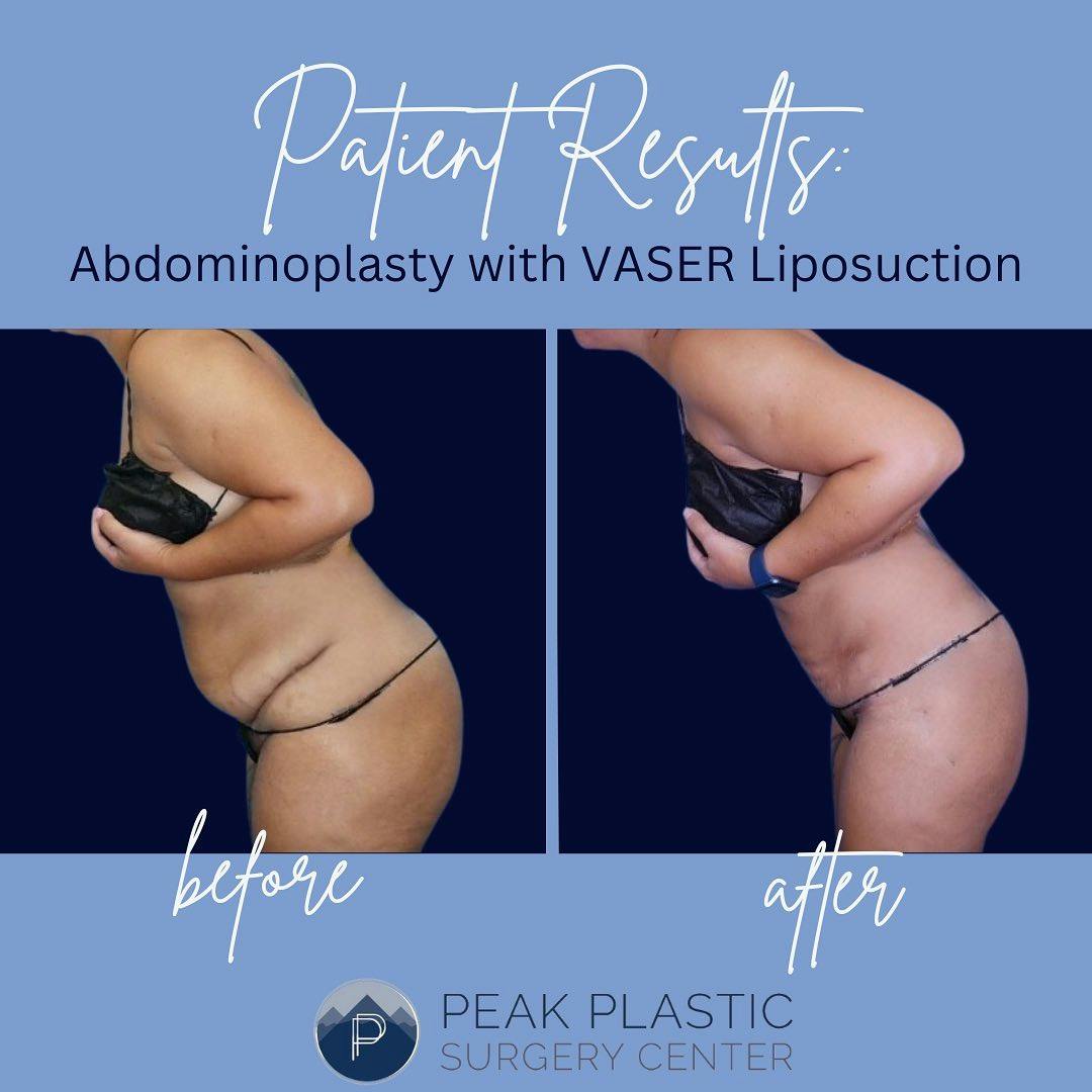 Tummy Tuck (Abdominoplasty)  Before & After Gallery - Patient 60747938 - Image 2