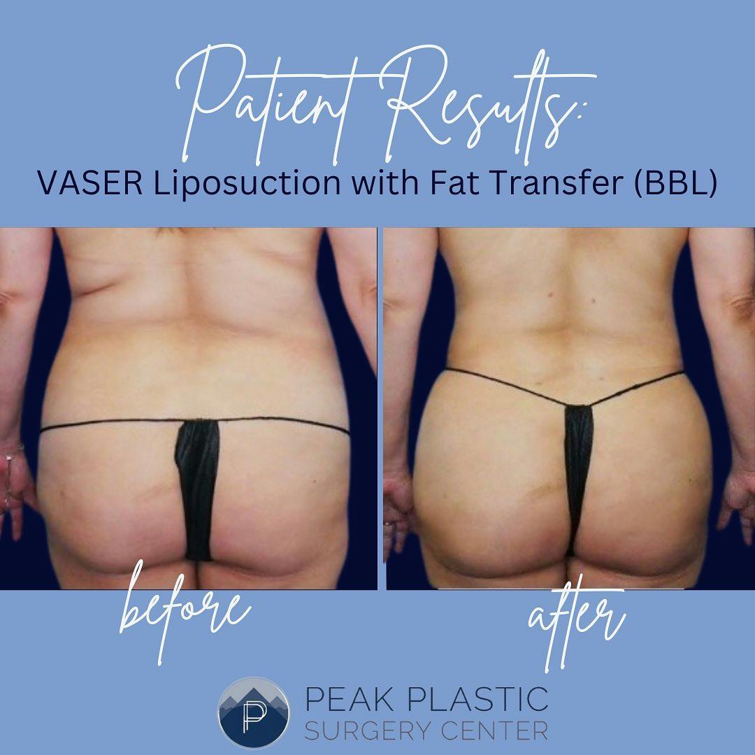 Vaser Liposuction Before & After Gallery - Patient 60748395 - Image 1